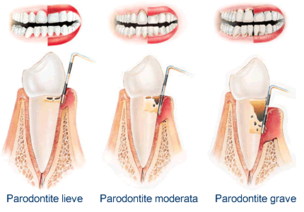 paradontite