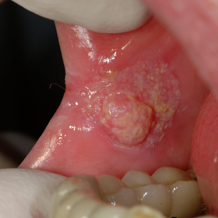 tumore cavo orale